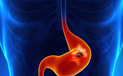 Management of Upper GI Bleeding CME