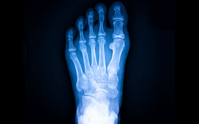 Anatomy and Function of the Foot and Ankle CME