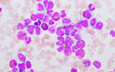 Laboratory Perspectives on Acute Myeloid Leukemia: Integrating Morphology, Cytochemistry, and Molecular Diagnostics CME